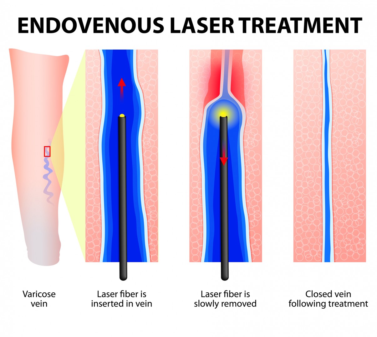 Varicose veins laser treatment (EVLT)