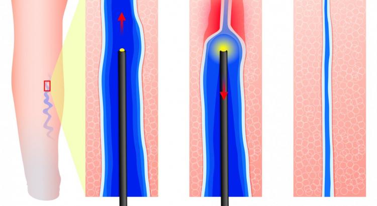 Varicose veins laser treatment (EVLT)