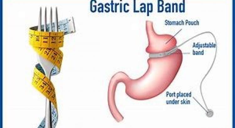 Gastric band fill