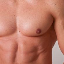 Male chest correction